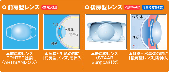 前房型レンズOPHTEC社製(ARTISANレンズ)角膜と虹彩の間に「前房型レンズ」を挿入 後房型レンズ(STAARSurgical社製)虹彩と水晶体の間に「後房型レンズ」を挿入