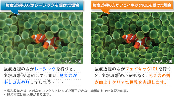 強度近視の方がレーシックを行うと、高次収差が増加してしまい、見え方が少しぼんやりしてしまう。強度近視の方がフェイキックIOLを行うと、高次収差の心配もなく、見え方の質が向上!クリアな世界を実現します。