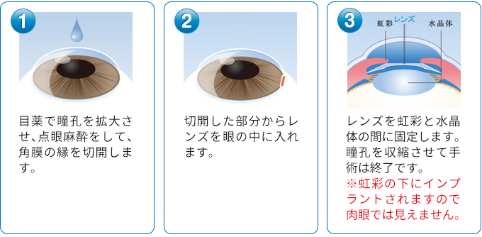 IPCL手術の流れ